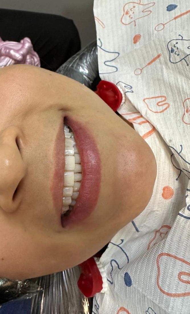 Blanqueamiento Dental - Después