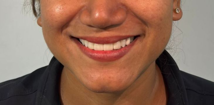 Carillas de composite premium - Después